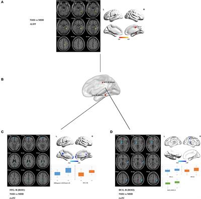 Disruption of Neural Activity and Functional Connectivity in Adolescents With Major Depressive Disorder Who Engage in Non-suicidal Self-Injury: A Resting-State fMRI Study